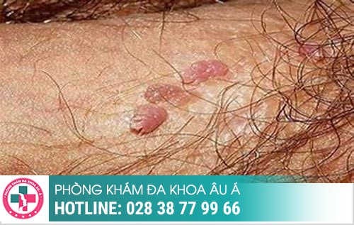 Thời gian ủ bệnh xã hội, bệnh xã hội ủ trong bao lâu, bệnh xã hội bao lâu tái phát Thời gian ủ bệnh xã hội, bệnh xã hội ủ trong bao lâu, bệnh xã hội bao lâu tái phát