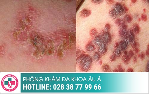 Thời gian ủ bệnh xã hội, bệnh xã hội ủ trong bao lâu, bệnh xã hội bao lâu tái phát Thời gian ủ bệnh xã hội, bệnh xã hội ủ trong bao lâu, bệnh xã hội bao lâu tái phát