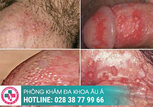 Hình ảnh nổi mụn trắng ở bìu tinh hoàn của nam giới