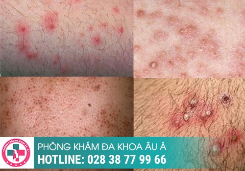 Nổi mụn li ti ở vùng kín là bệnh gì?