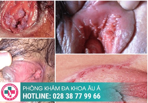 Hình ảnh nhận biết sùi mào gà ở nữ