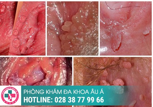 Hình ảnh nhận biết sùi mào gà ở nữ