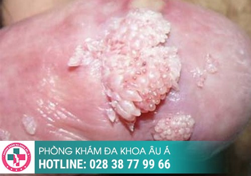 hình ảnh sùi mào gà