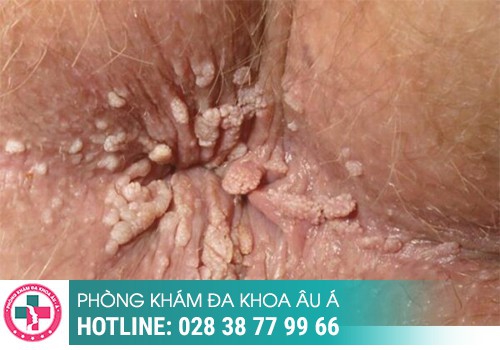 Bệnh sùi mào gà, căn bệnh dễ lây nhiễm nhưng khó điều trị