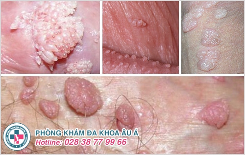 nổi mụn dương vật