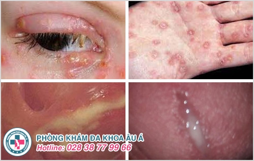 quan hệ tình dục không an toàn