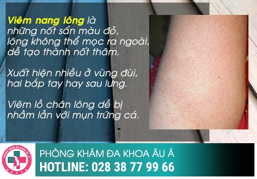 Cách chữa mụn vùng kín 