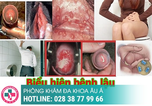 Hình ảnh bệnh lậu ở nam