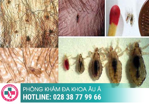 Mụn đỏ ở vùng kín là bệnh gì?