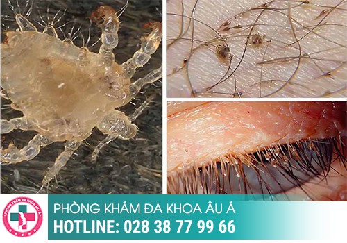 Thuốc trị rận mu loại nào tốt và hiệu quả nhất?