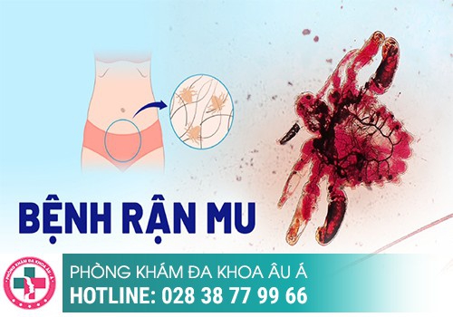 Thuốc trị rận mu loại nào tốt và hiệu quả nhất?