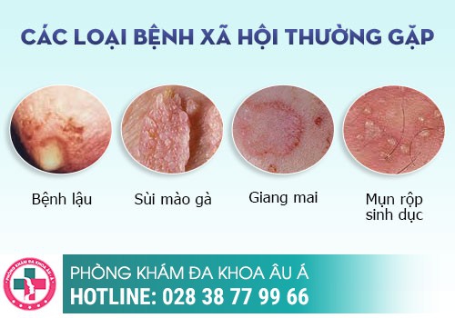 CHỈ MỘT LẦN “ĐỔI GIÓ” VỚI GÁI MẠI DÂM ĐÃ MẮC SÙI MÀO GÀ