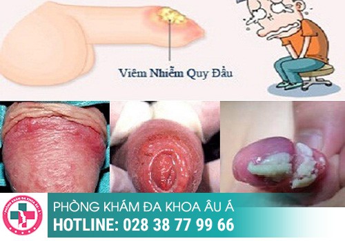 Một số hình ảnh bựa sinh dục ở nam thường gặp