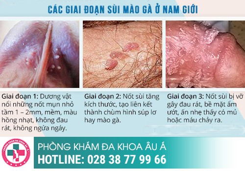 sùi mào gà ở nam giới