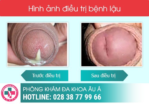 Điều trị bệnh lậu bao lâu thì khỏi?