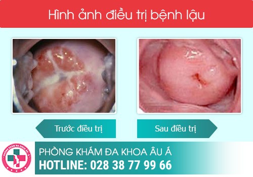 Điều trị bệnh lậu bằng kỹ thuật DHA