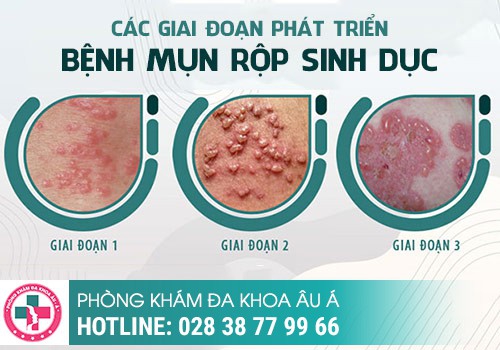 Nổi mụn ở vùng kín là bệnh gì?