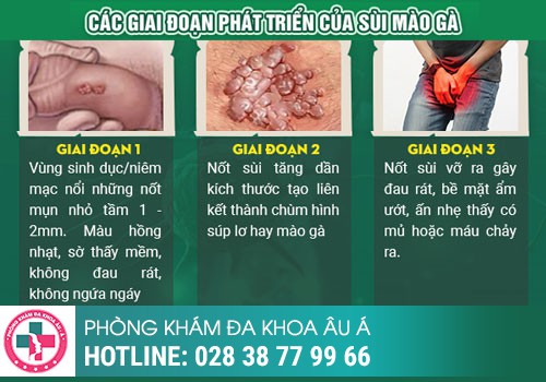 Cách nhận biết sùi mào gà, Nhận biết sùi mào gà bằng cách nào