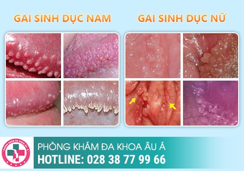 Nổi mụn trứng cá ở vùng kín nữ là bị bệnh gì?