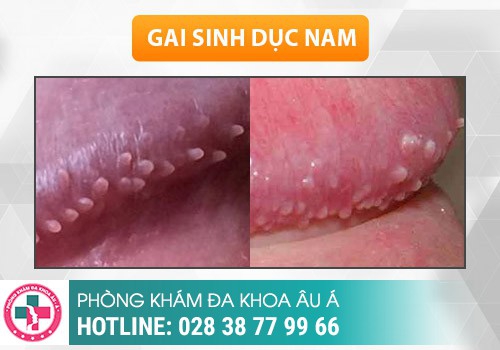 hình ảnh gai sinh dục