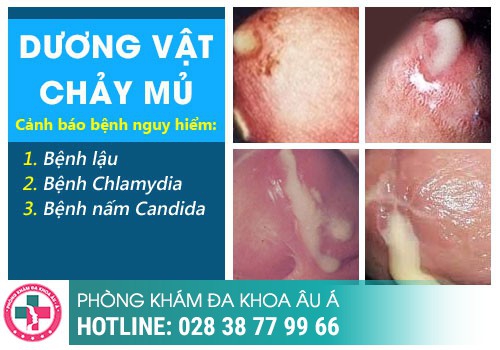 dương vật chảy mủ trắng đục