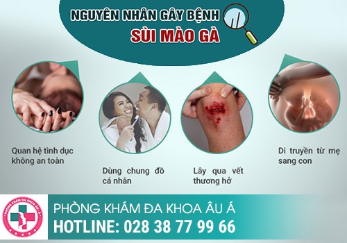 Nguyên nhân gây sùi mào gà ở lưỡi do đâu?