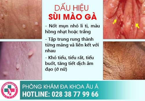 Những bệnh xã hội ở nam giới thường gặp