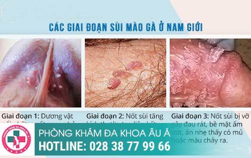Sùi mào gà dương vật – bệnh nguy hiểm, khó đề phòng