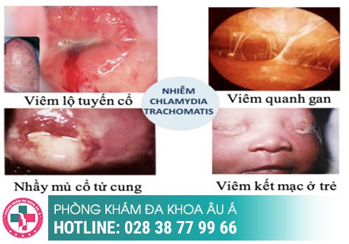 bệnh lây qua đường quan hệ tình dục