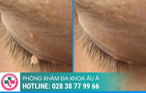 Phương pháp đốt điện công nghệ mới