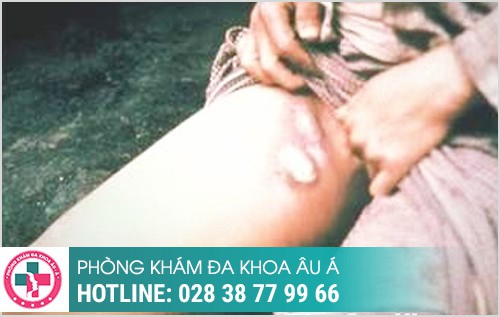 hình ảnh nổi hạch ở bẹn háng