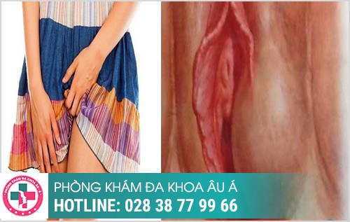 nỗi hạch ở vùng kín nữ có sao không
