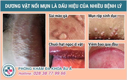 dương vật nổi mụn