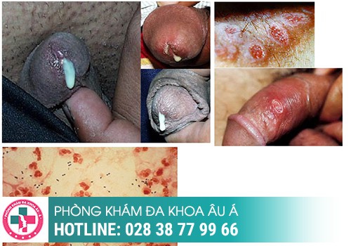 Đau buốt đầu dương vật