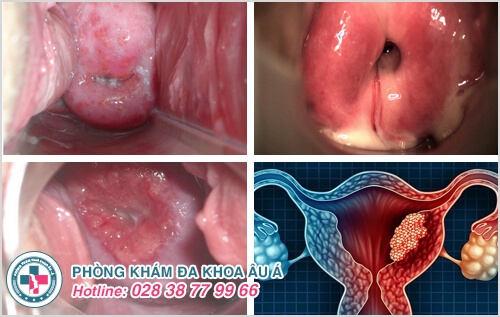 Các bệnh viêm nhiễm sinh dục thường gặp ở nam và nữ