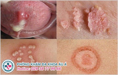 Các bệnh lây qua đường tình dục