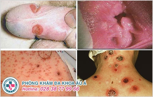 cách chữa bệnh giang mai