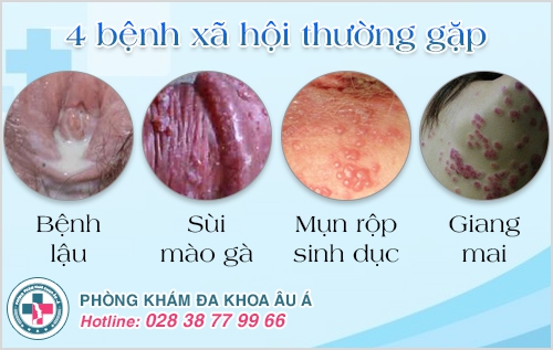Chẩn đoán và tư vấn bệnh xã hội miễn phí