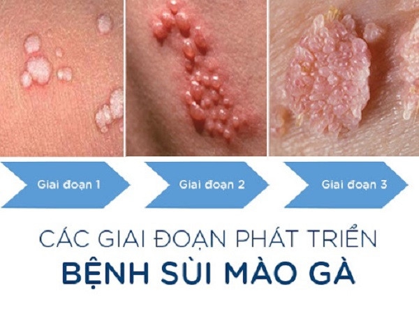 Sùi mào gà - Bệnh dễ lây nhiễm nhưng khó điều trị