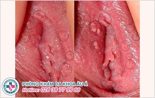 Hình ảnh gai sinh dục ở nữ
