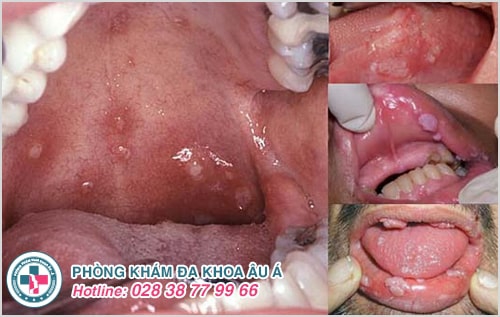 Hết lo lắng sùi mào gà ở họng nhờ phương pháp này