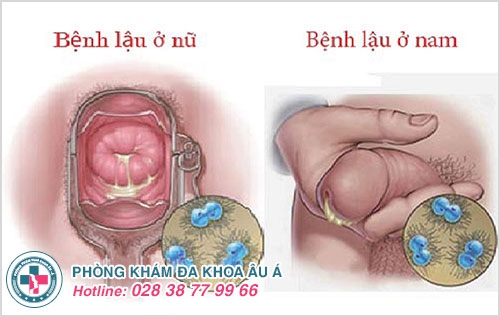 Kiến thức y khoa về bệnh lậu cần biết