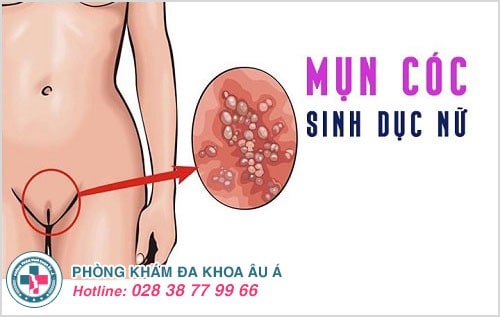 Coi chừng mụn cóc sinh dục vì bệnh dễ lây truyền　