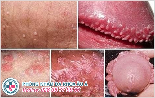 mụn dương vật