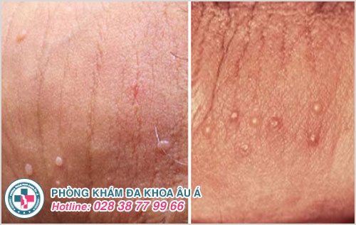 Chi tiết hình ảnh và biểu hiện sùi mào gà giai đoạn đầu