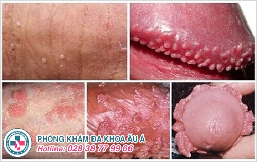 Mọc mụn ở dương vật quý ông chớ xem thường