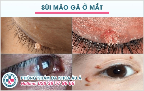 Biểu hiện sùi mào gà ở mắt