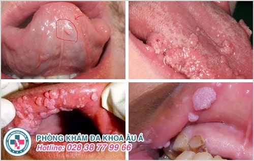 Sùi mào gà ở miệng có nguy hiểm như thế nào?