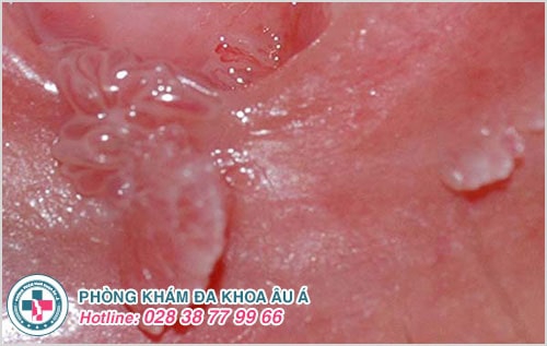 Chi tiết hình ảnh và biểu hiện sùi mào gà giai đoạn đầu