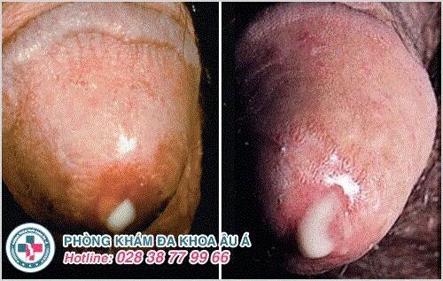 hội chứng tiết dịch niệu đạo